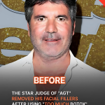 ‘AGT’ Star Simon Cowell Removed His Facial Fillers After Not Recognizing Himself – Before & After Photos