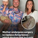 Mom-of-two, 34, undergoes a dozen surgeries to replace her dying bones- which doctors link to the Covid vaccine