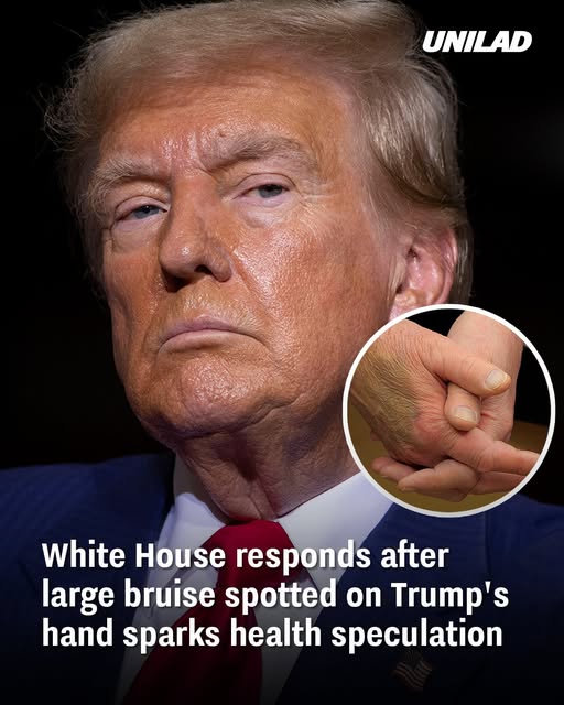 White House responds after large bruise spotted on Trump’s hand sparks health speculation