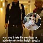 Man who broke his own legs to add 9 inches to his height speaks out on his experience