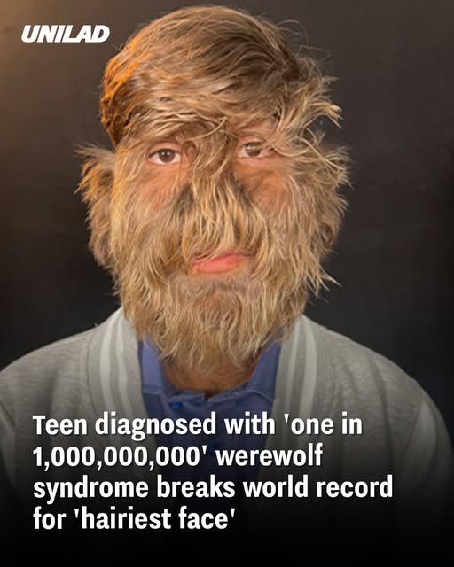 Teen diagnosed with ‘one in 1,000,000,000’ werewolf syndrome breaks world record for ‘hairiest face’