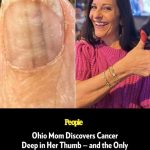 Ohio Mom Discovers Cancer Deep in Her Thumb — and the Only Sign Was 2 Thin Lines on Her Nail