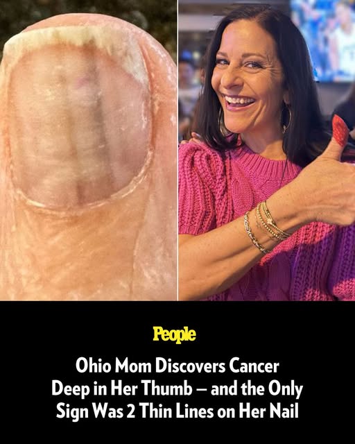 Ohio Mom Discovers Cancer Deep in Her Thumb — and the Only Sign Was 2 Thin Lines on Her Nail