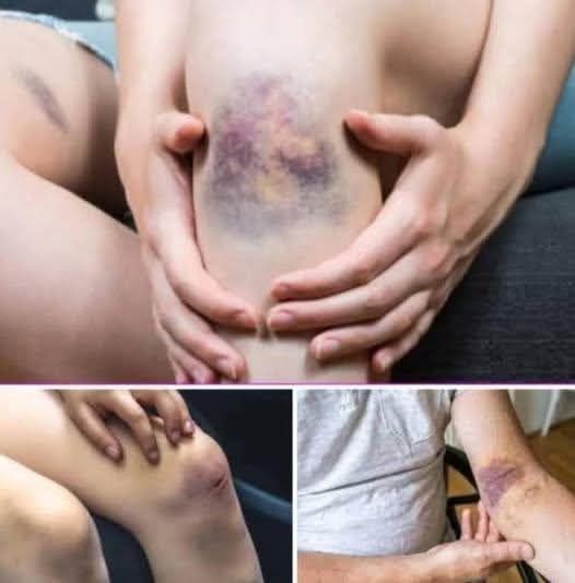 BE CAREFUL, if you get these bruises on your body, it means you have Ca…