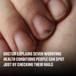 Doctor Reveals 7 Health Conditions You Can Spot By Just Checking Your Nails