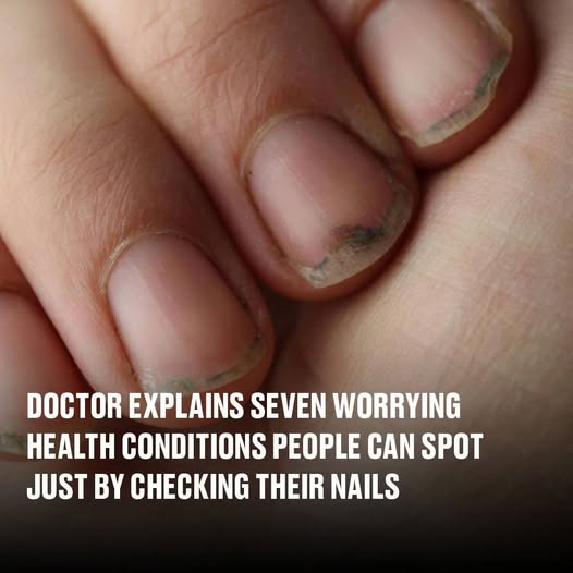 Doctor Reveals 7 Health Conditions You Can Spot By Just Checking Your Nails
