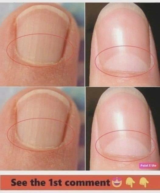 If You Don’t Have A Half Moon Shape On Your Nails, Visit A DOCTOR Immediately…