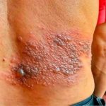 Young woman dies at the hands of her…See moreIt was itching his body, he thought it was an allergy, but a tough diagnosis… See more