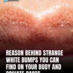 The Cause Of The Odd White Pimples On Your Your Body