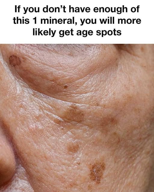 How To Reduce Age Spots: Causes, Treatment, and Prevention