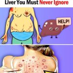 Fatty Liver: Causes, Symptoms, Treatment & Home Remedies