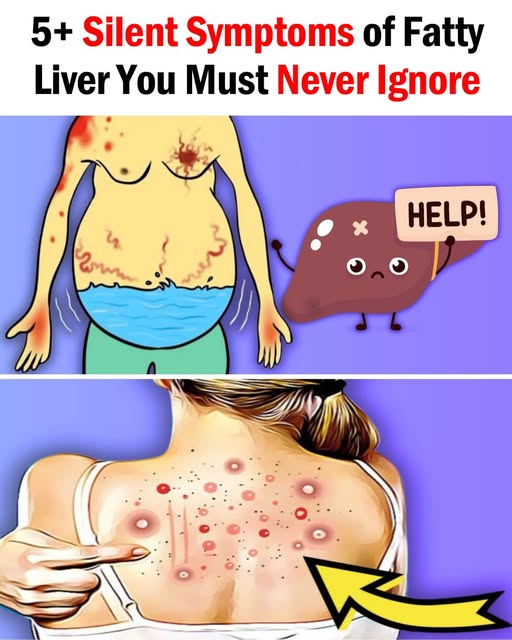 Fatty Liver: Causes, Symptoms, Treatment & Home Remedies