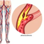 5 Health Conditions That Can Cause Visible Veins