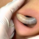 Larvae found in a young woman…