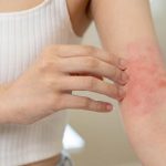 SB. Small Red Spots on the Skin Could Indicate Scabies: What You Need to Know