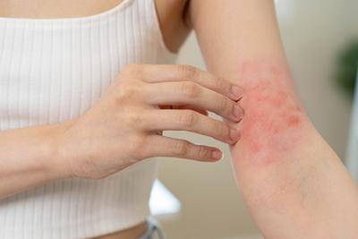 SB. Small Red Spots on the Skin Could Indicate Scabies: What You Need to Know